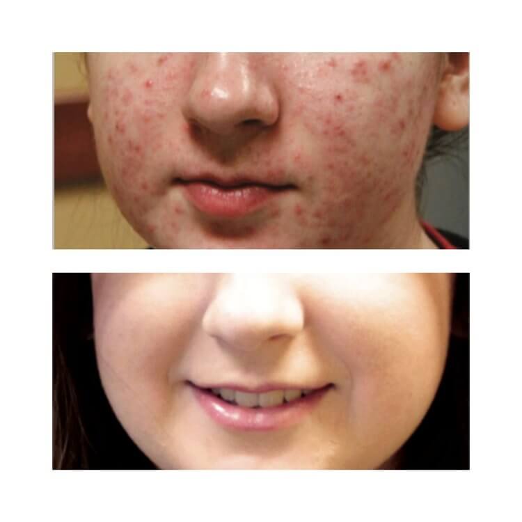 BBL laser treatment before and after photo showing improved skin.