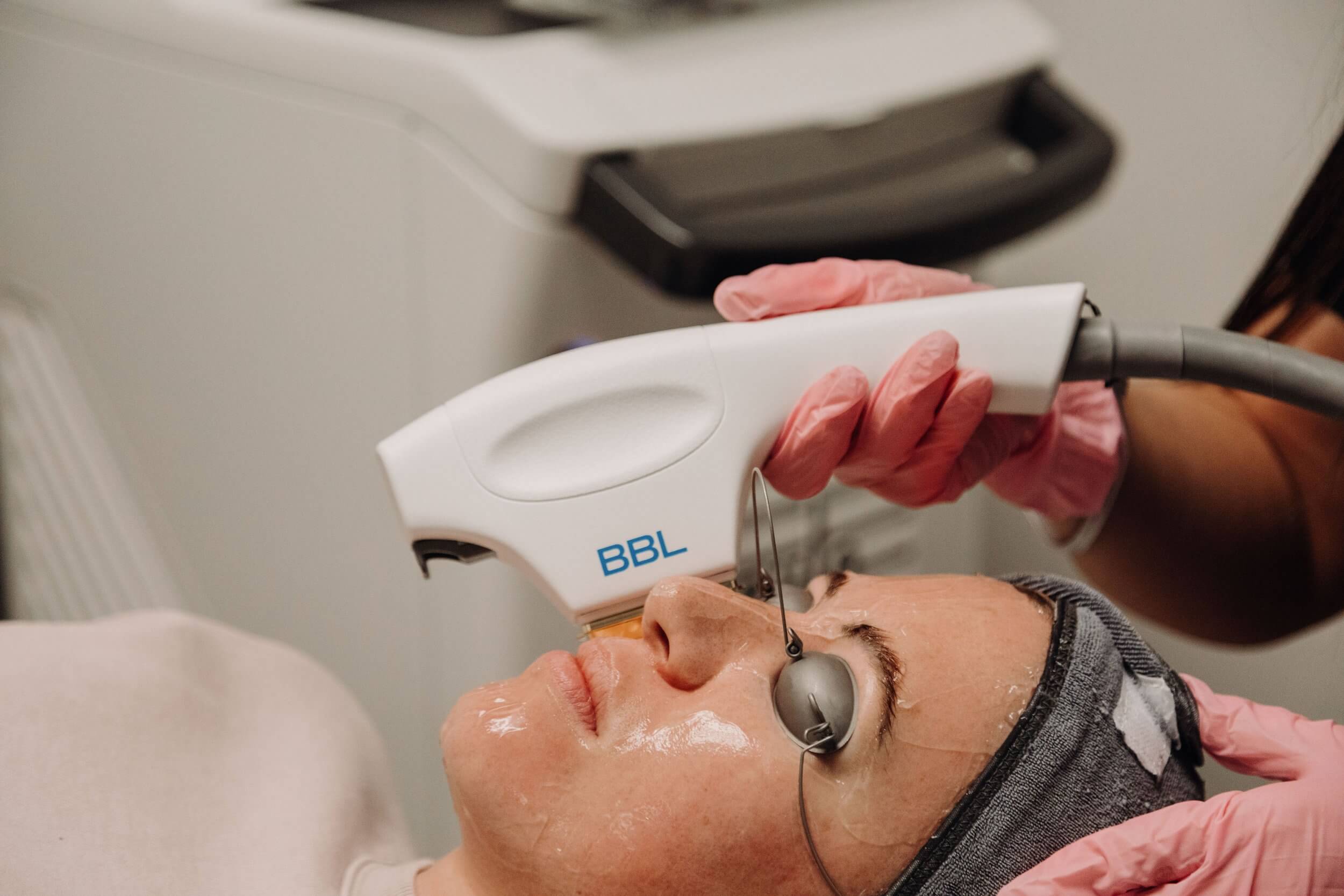 Woman receiving BBL laser treatment on her face.