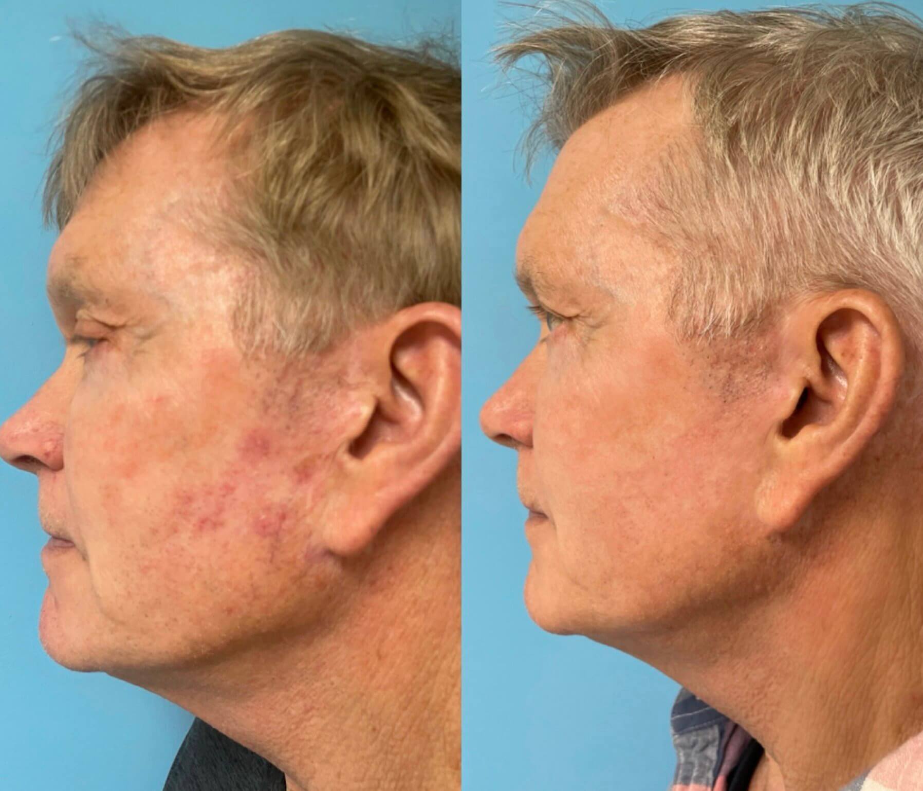 Moxi Laser treatment before and after for sun damage and uneven tone, London, Ontario.