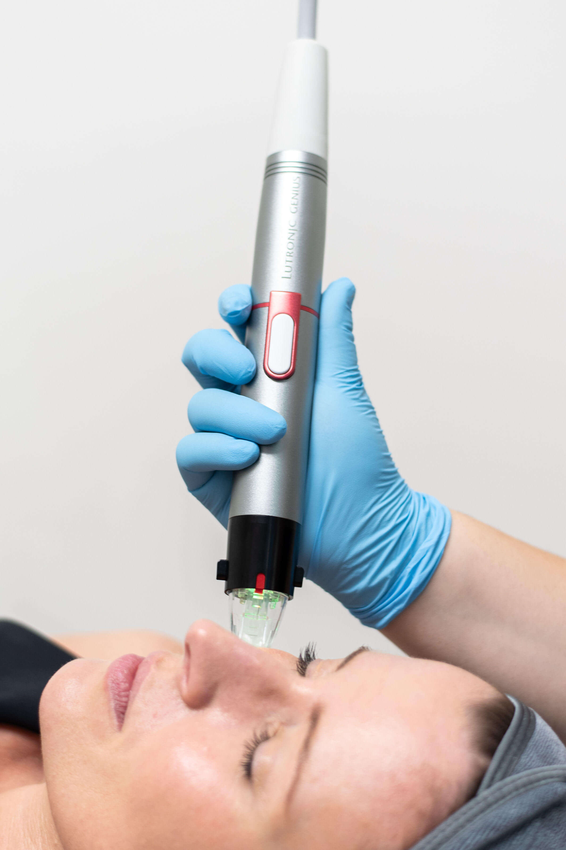 microneedling London Ontario | microneedling near me