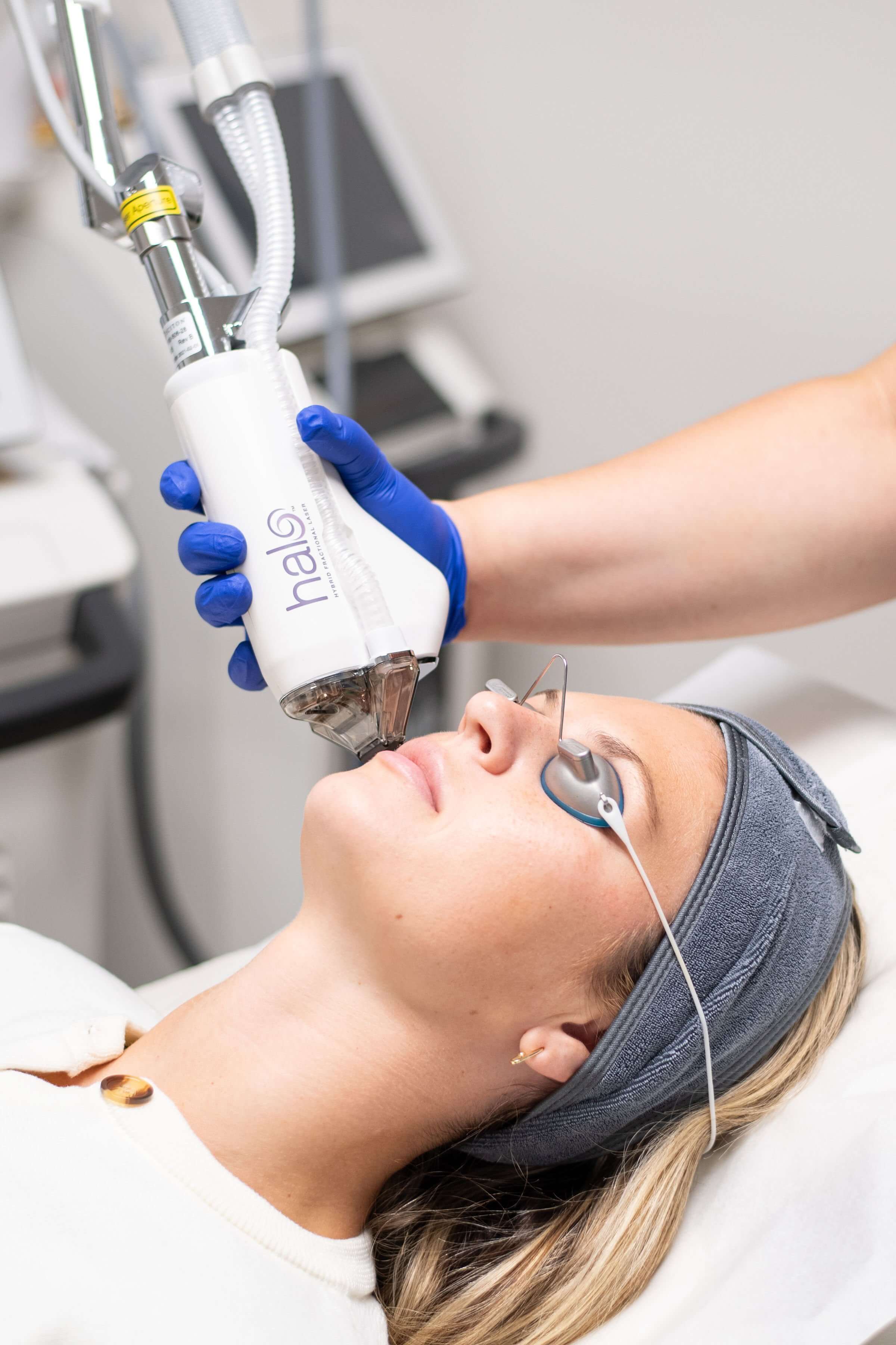 Halo Laser treatment before and after for sun damage and texture, London, Ontario