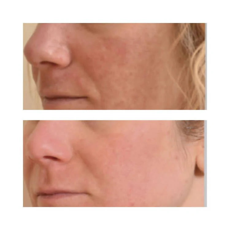 Halo Laser treatment , halo laser before and after at London Plastic Surgery & Advanced Aesthetics