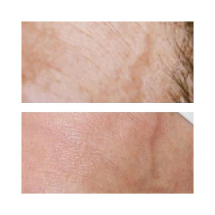 BBL laser treatment before and after photo showing improved skin.