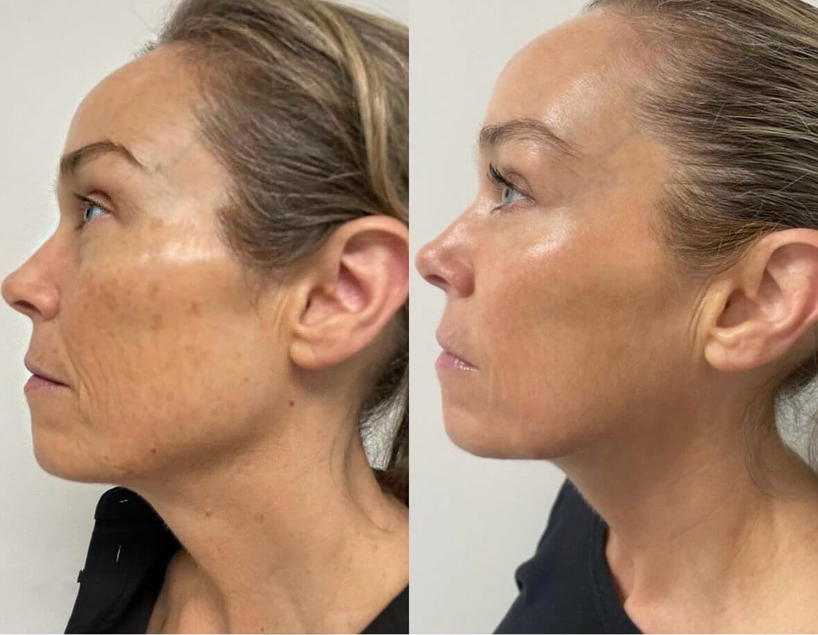 Moxi Laser treatment before and after for sun damage and uneven tone, London, Ontario.