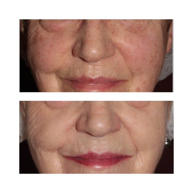BBL laser treatment before and after photo showing improved skin.