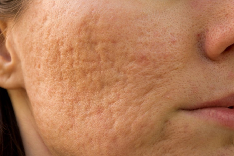 Acne scars on the face