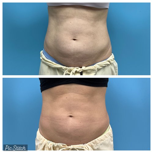 Coolsculpting London Ontario at london plastic Surgery &  Advanced Aesthetics