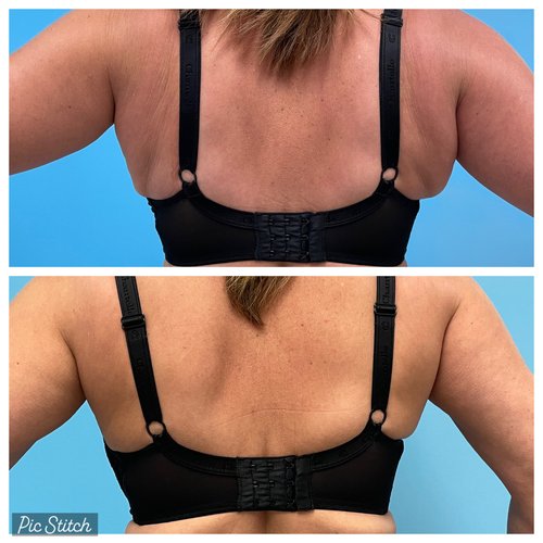 Coolsculpting London Ontario at london plastic Surgery &  Advanced Aesthetics