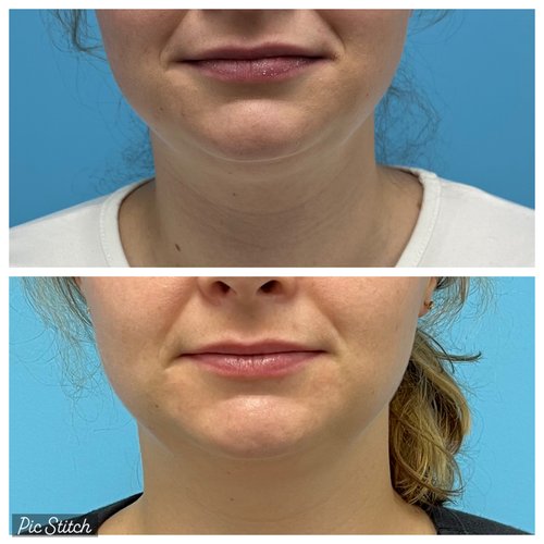 Coolsculpting London Ontario at london plastic Surgery &  Advanced Aesthetics