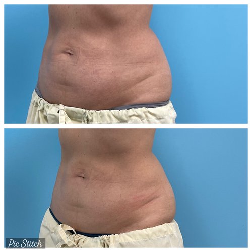 Coolsculpting London Ontario at london plastic Surgery &  Advanced Aesthetics