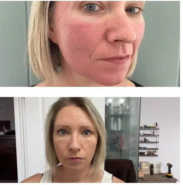 Halo Laser treatment before and after for sun damage and texture, London, Ontario