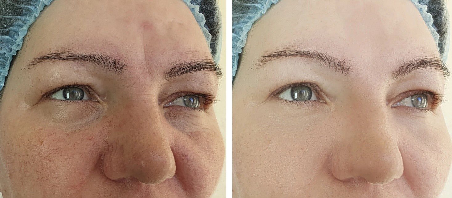 Before and after pictures of laser treatment.