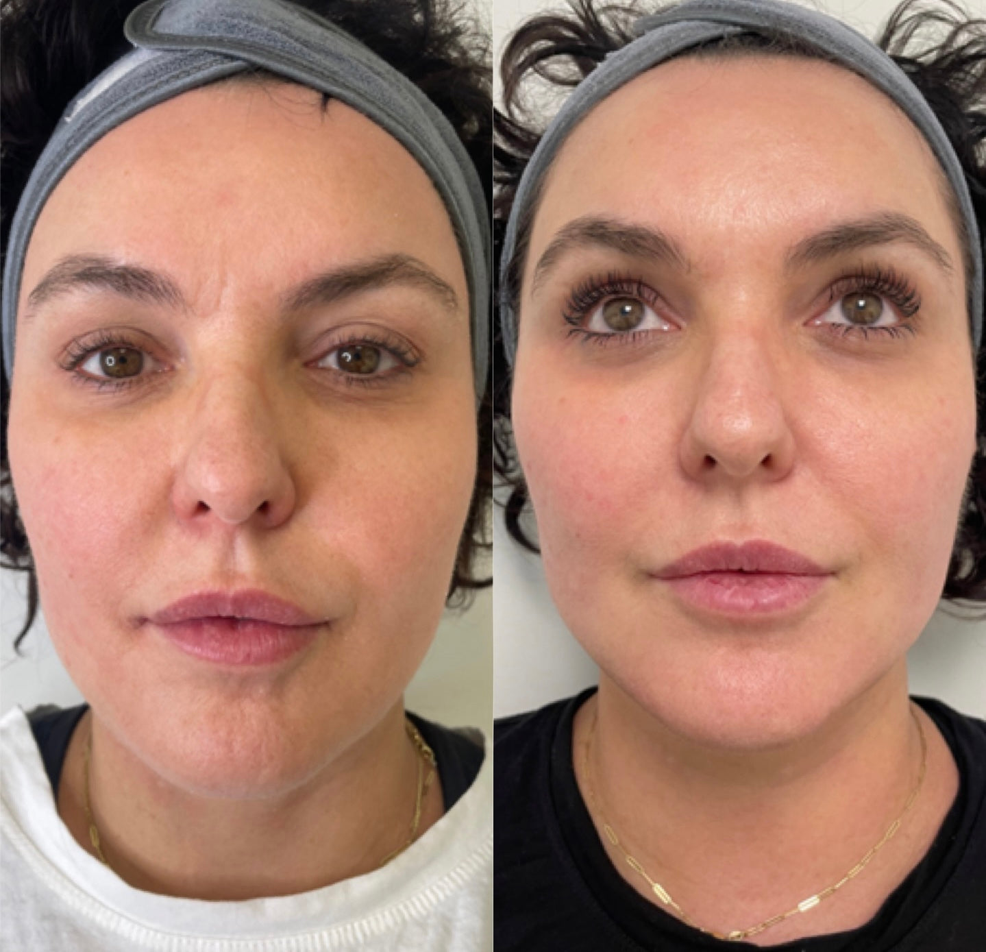 Before and after microneedling showing smoother skin texture and post-treatment recovery results