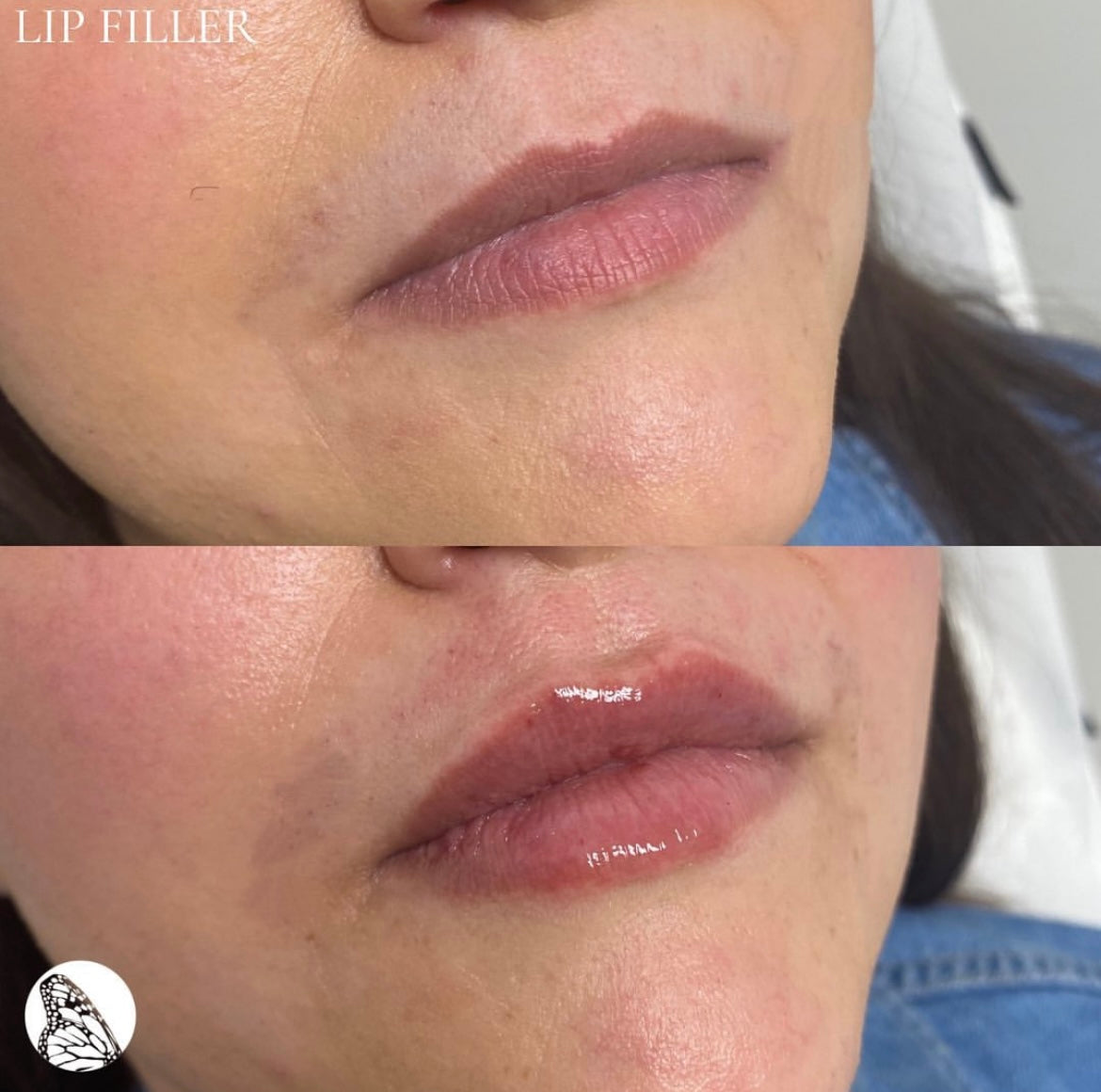 Before and after lip filler showing improved upper lip balance and natural contour enhancement