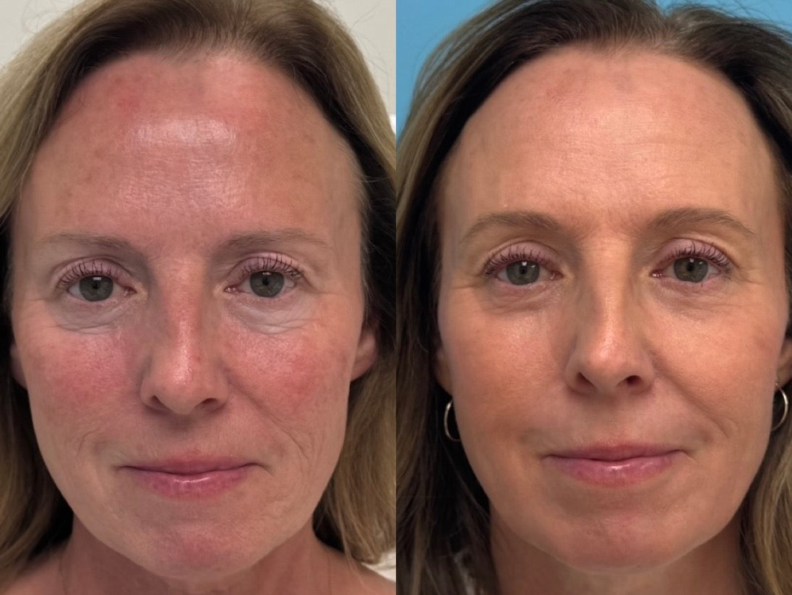 Not Quite Ready for a Facelift? Discover the LPS Laser Lift.