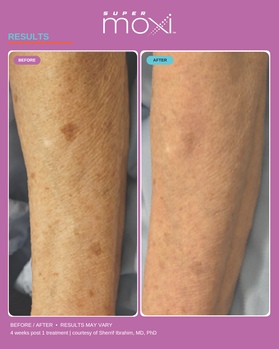 Super MOXI by Sciton: The Next Evolution in Full-Body Laser Skin Rejuvenation