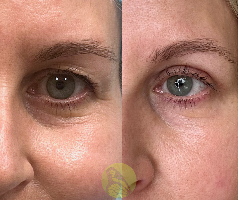 Before and after blepharoplasty showing refreshed eyes and reduced puffiness