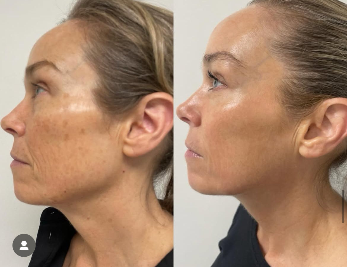Before and after laser skin rejuvenation showing improved tone, texture, and smoother skin appearance