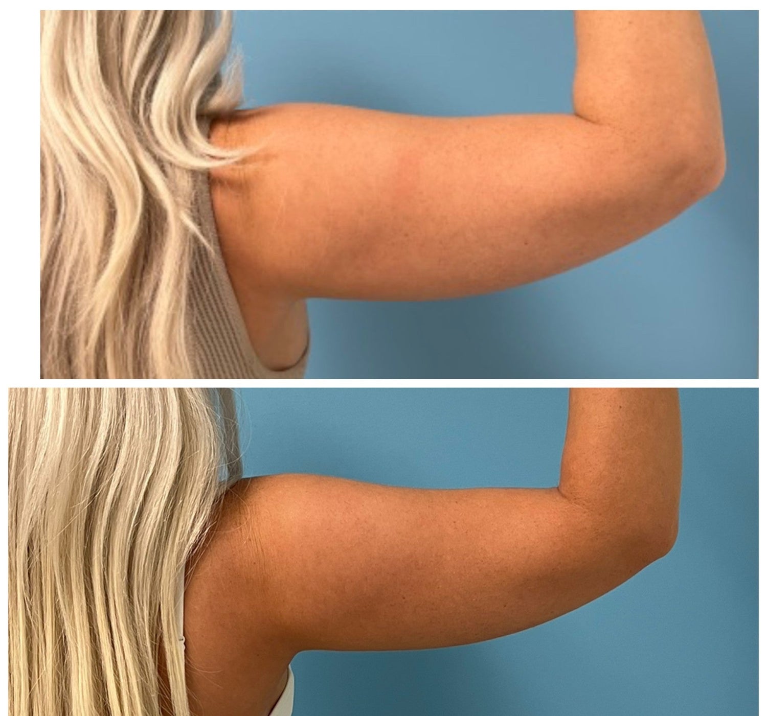 Before and after upper arm contouring showing smoother, more toned arm appearance