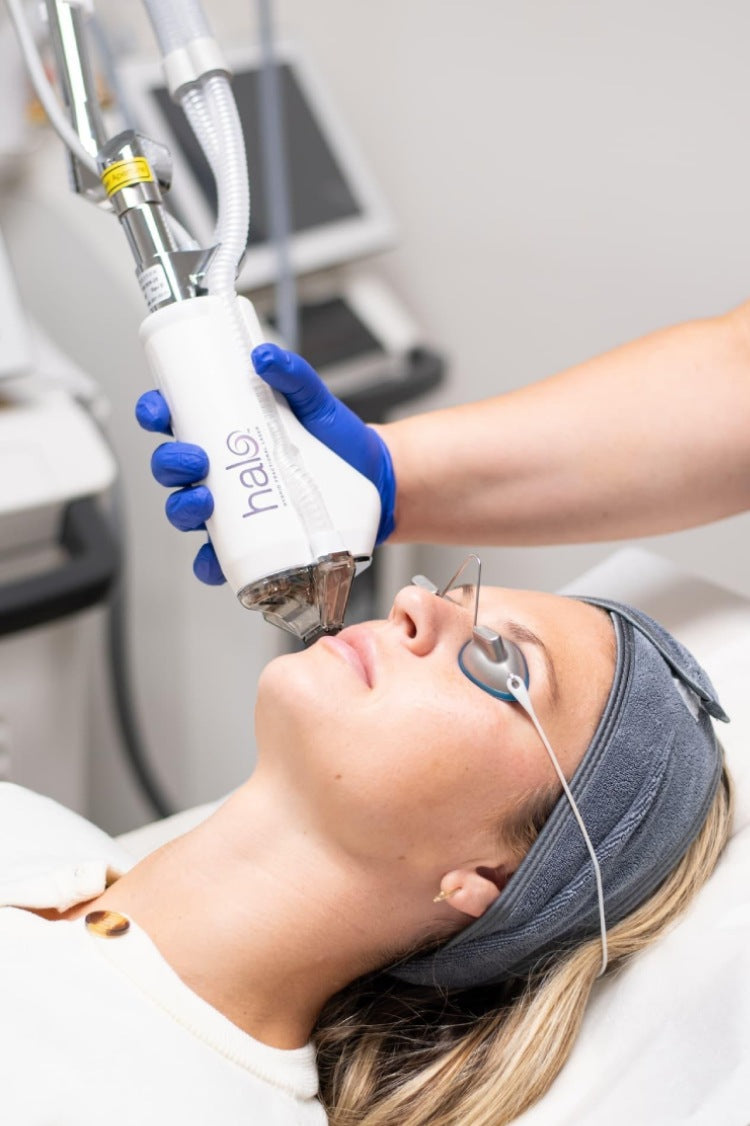 A young woman is getting laser Halo treatment for acne scars