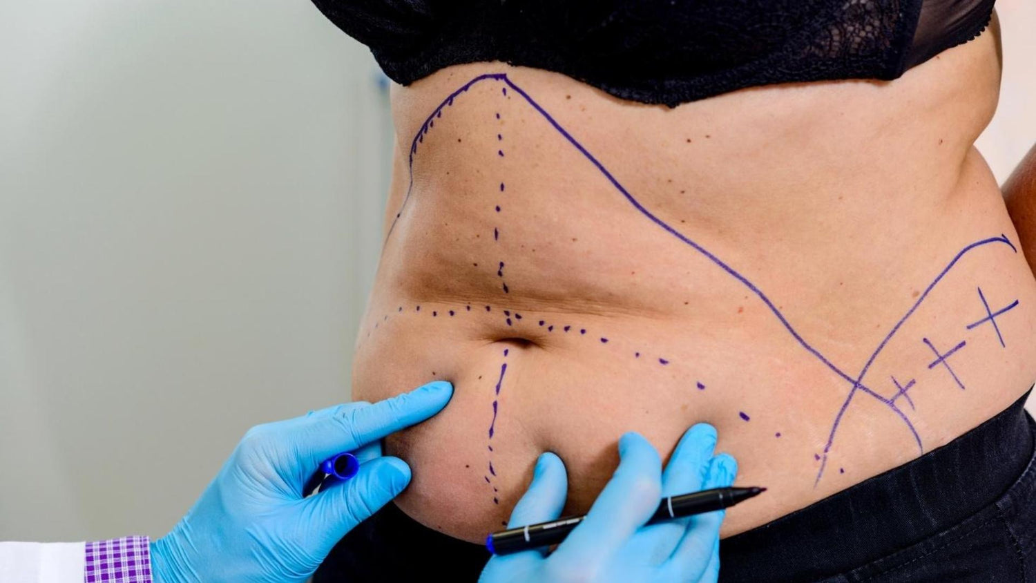 A woman is undergoing a tummy tuck consultation.