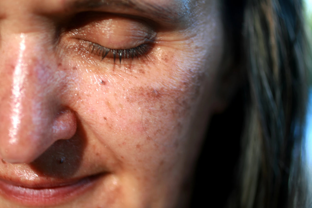 pigmented skin on cheek